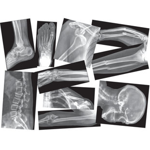 ROYLCO INC Broken Bones X-rays Educational Tool